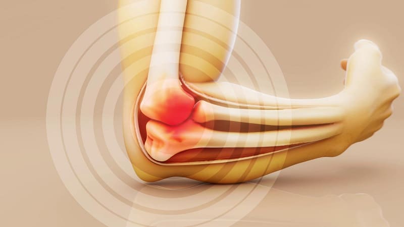 تصوير توضيحي لالتهاب مفصل الركبة بسبب الروماتيزم